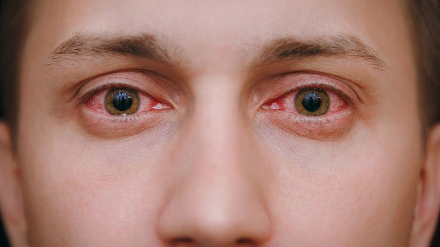 عوارض لنز چشم: 18 مورد از صدمات جدی و جبران ناپذیر لنزهای چشمی