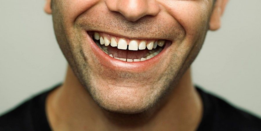 دیاستما یا فاصله بین دندان‌ ها 