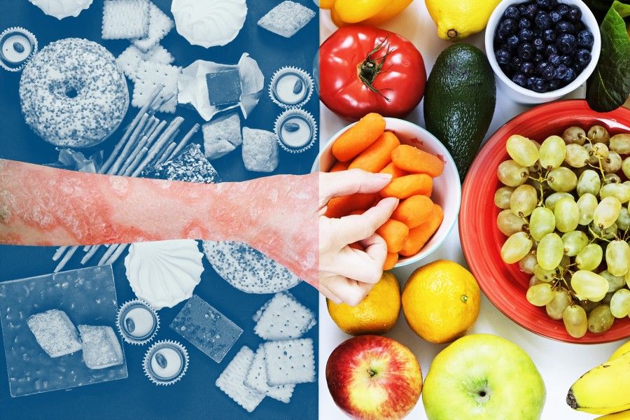 رژیم غذایی پسوریازیس