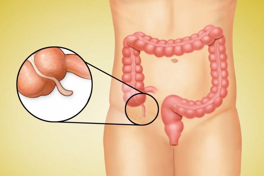آپاندیس چیست و چه کاربردی دارد؟