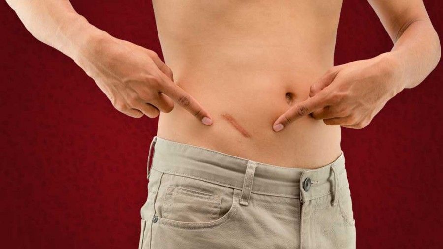 آپاندیس چیست و چه کاربردی دارد؟