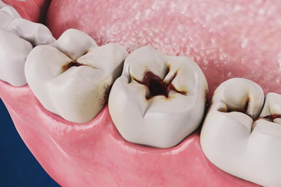 مصرف شیشه چه تاثیری بر سلامت دندان ها دارد؟ 