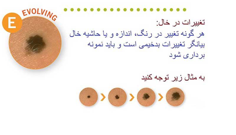 خال های سرطانی