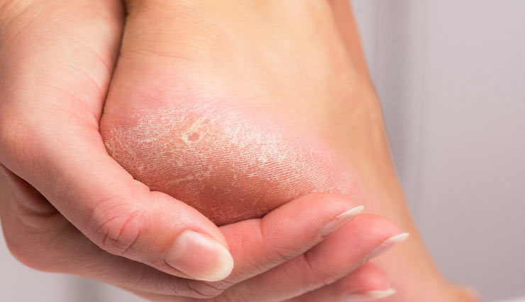 راهکارهای مؤثر برای از بین بردن پوست مرده کف پا