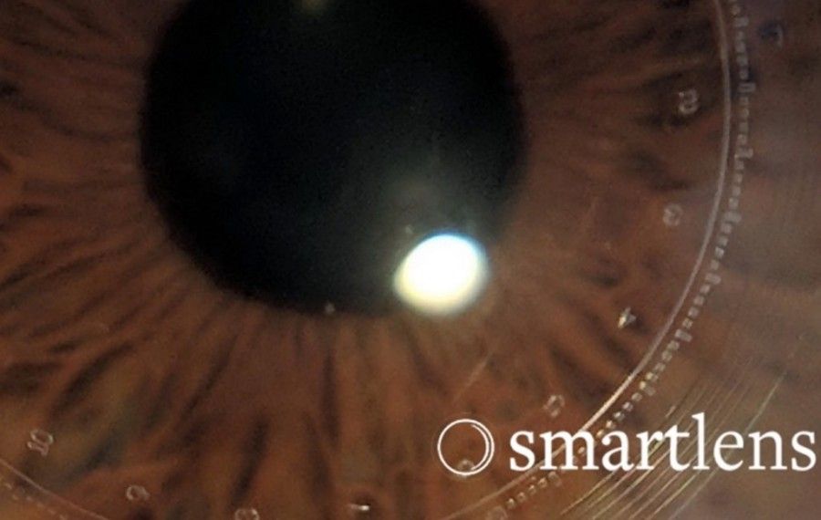  لنز تماسی miLens می‌تواند فشار داخل چشم بیماران مبتلا به گلوکوم را به صورت پیوسته اندازه‌گیری کند
