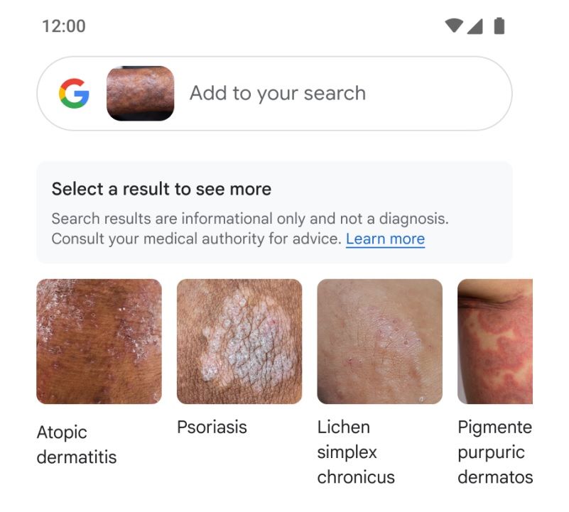 توانایی جالب گوگل لنز در جست و جوی بیماری‌ های پوستی 