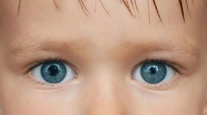 رنگ چشمان فرد مبتلا به انیزوکوریا