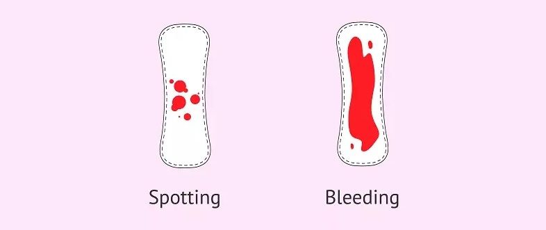 خونریزی در بارداری 