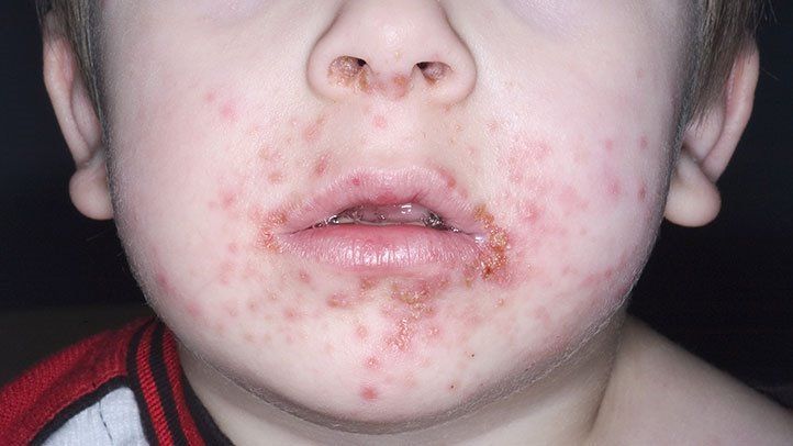  زرد زخم در کودکان: بیماری پوستی نادر که نیازمند توجه و درمان جدی است!