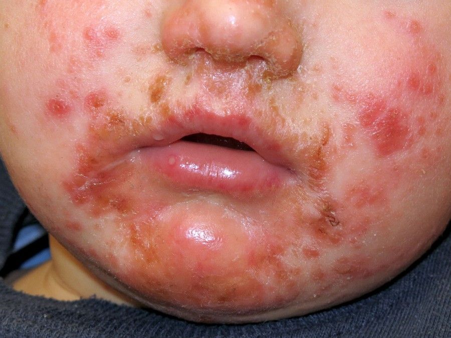  زرد زخم در کودکان: بیماری پوستی نادر که نیازمند توجه و درمان جدی است!