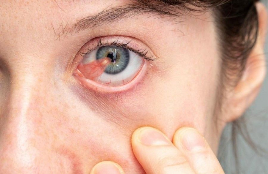 ناخنک چشم: دلایل ایجاد ناخنک چشم چیست؟ 