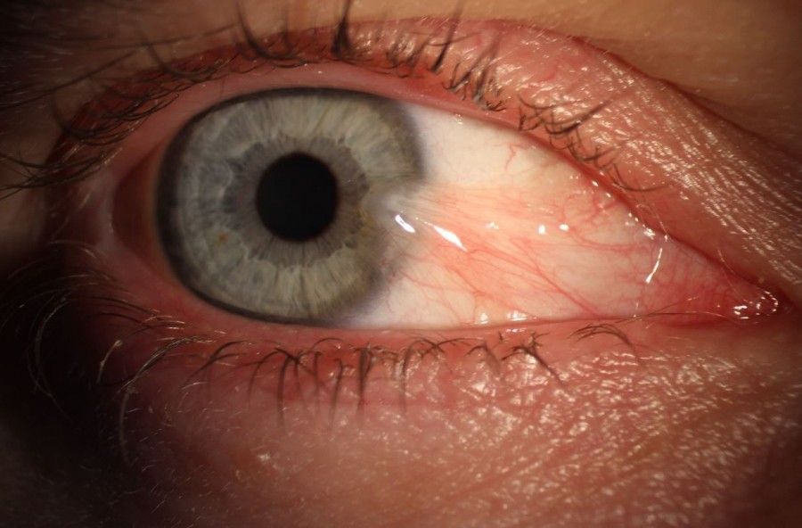ناخنک چشم: دلایل ایجاد ناخنک چشم چیست؟ 