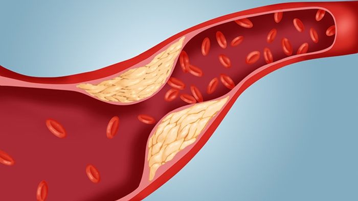 اگر کلسترول بالا دارید، از این مواد غذایی استفاده کنید