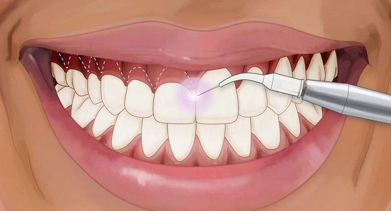 مراقبت های لازم بعد از جراحی لیفت لثه