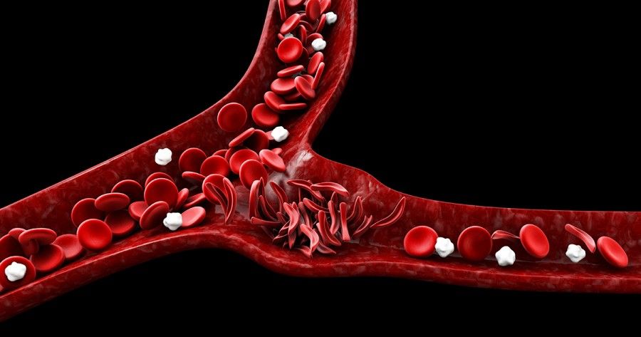 بیماری سلول داسی شکل چیست؟ علائم، علل، تشخیص و درمان
