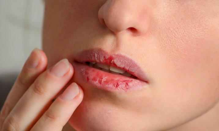اصلی ترین علل ترک خوردن و خشکی لب ها