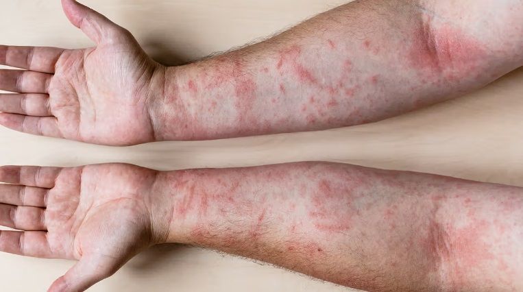 آشنایی با انواع بیماری های پوستی خارش دار