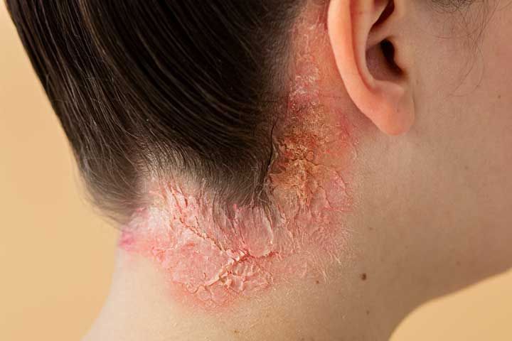 آشنایی با انواع بیماری های پوستی خارش دار
