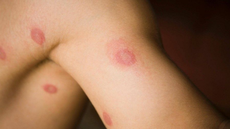 آشنایی با انواع بیماری های پوستی خارش دار