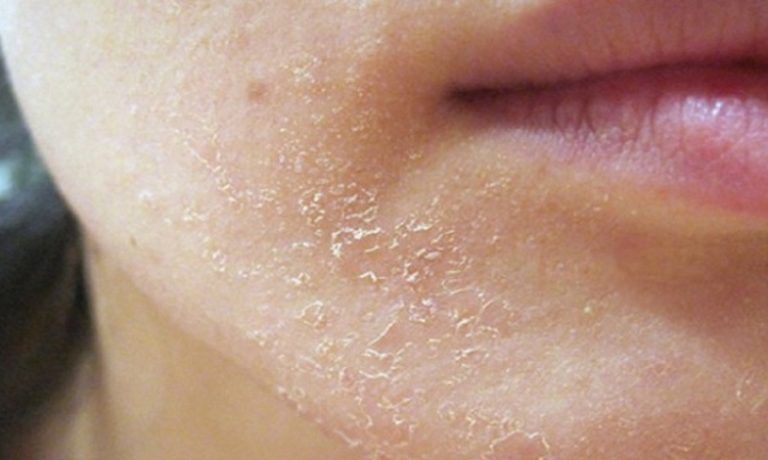 آشنایی با انواع بیماری های پوستی خارش دار