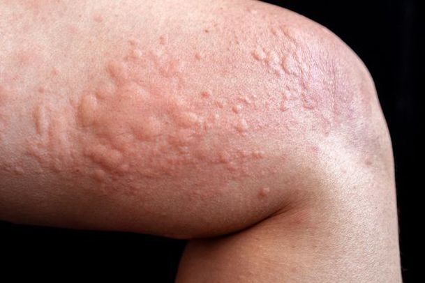 آشنایی با انواع بیماری های پوستی خارش دار