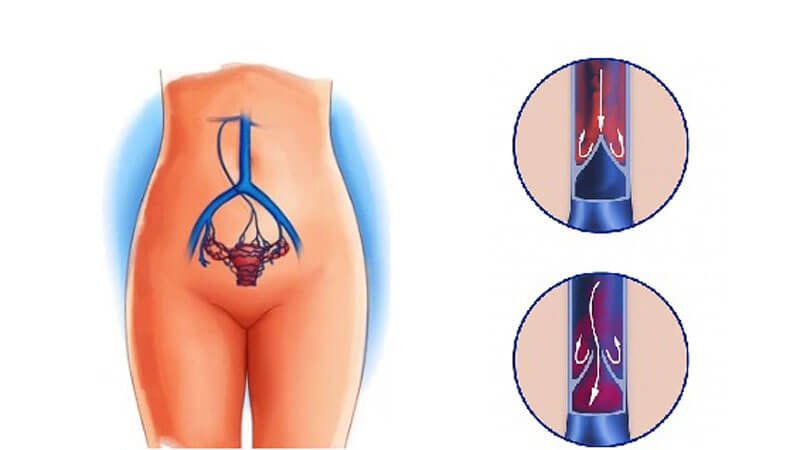 پیشگیری از واریس لگن: علل و علائم آن را بشناسید