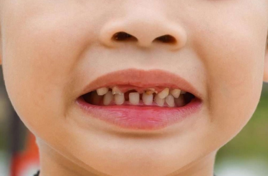 این عادت های ساده دندان های شیری کودکان را ویران می کنند! 