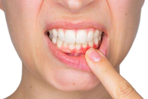 بیماری پیوره | بیماری عفونتی بافت های اطراف دندان 