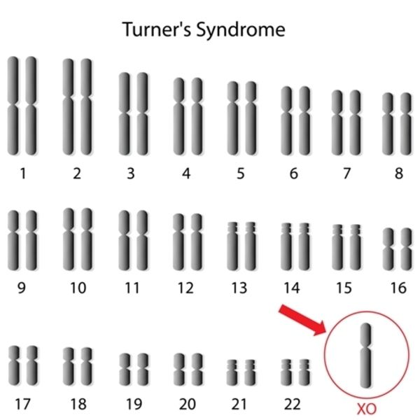 سندرم ترنر (Turner Syndrome) 