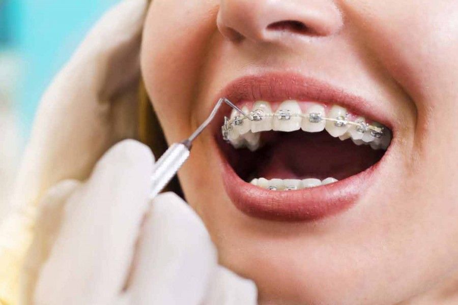 مال اکلوژن | ناهماهنگی و عدم تراز دندان ها 