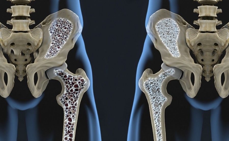 پوکی استخوان و سلامتی استخوان‌ها: راهنمایی کامل برای حفظ استحکام استخوانی