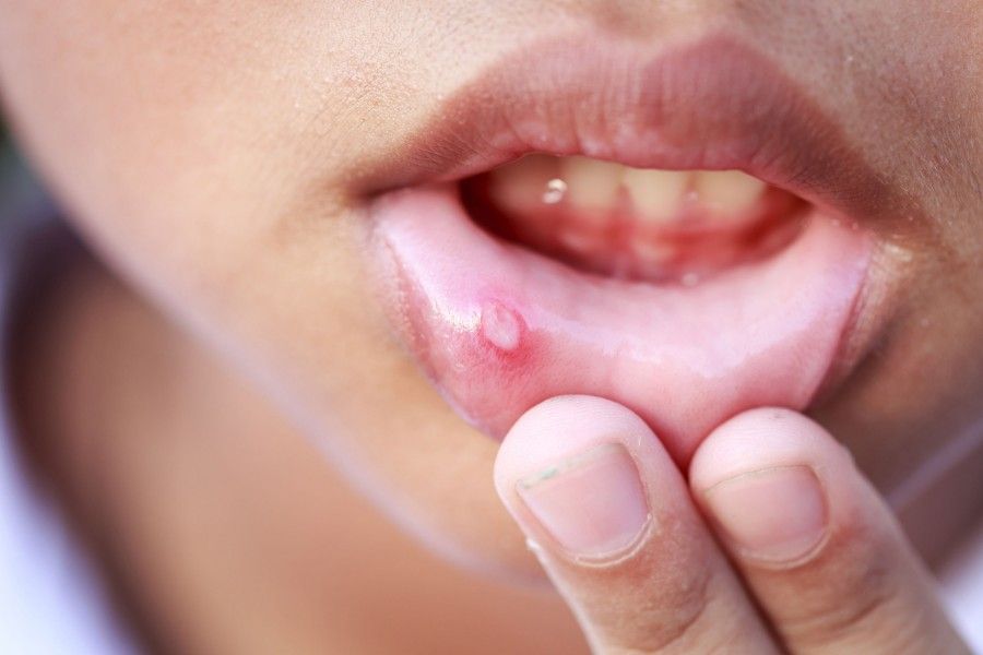 آفت دهانی | زخم های دردناک داخل دهان 