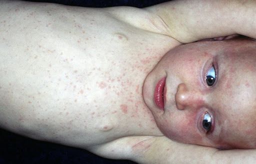 بیماری سرخ جوش در کودکان: آیا بیماری سرخ جوش یا روزئولا در کودکان قابل درمان است؟!