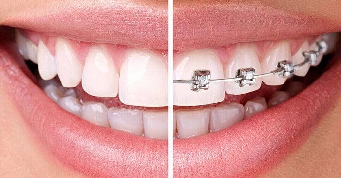 ارتودنسی | اطلاعات کامل در مورد ارتودنسی دندان 