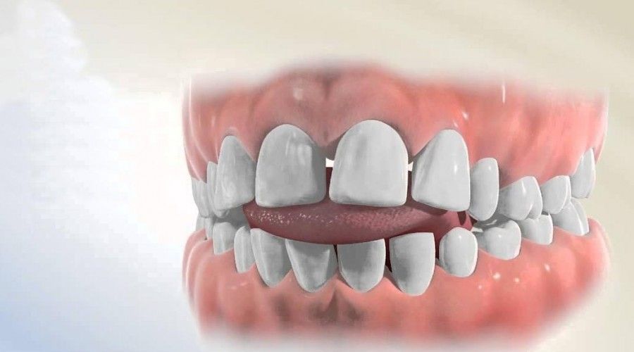 بایت های دندانی | انواه بایت های دندانی 