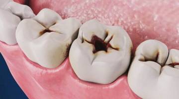 مصرف شیشه چه تاثیری بر سلامت دندان ها دارد؟